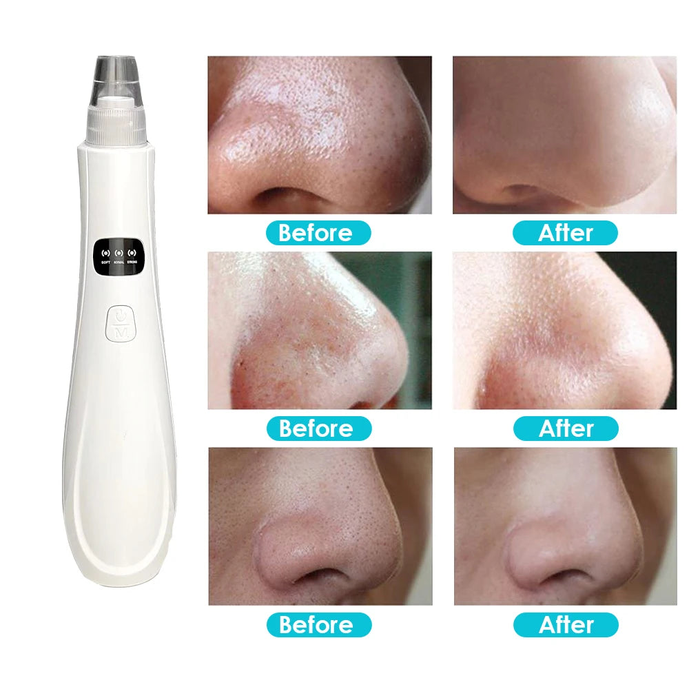 3 Suction Vacuum Facial Blackhead Removal